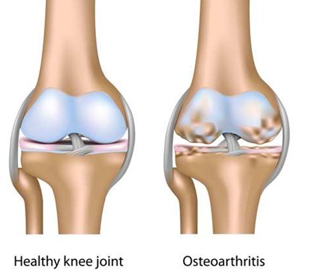 Healthy knee and osteoarthritis